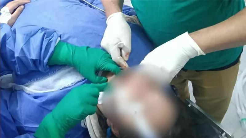  جراحة دقيقة بالوجه والفكين لفتاة من ذوي الهمم بمستشفى مشتول السوق